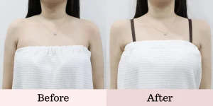 Read more about the article When a Trend Goes Too Far: Shoulder Injections for the “Perfect Silhouette” in Seoul